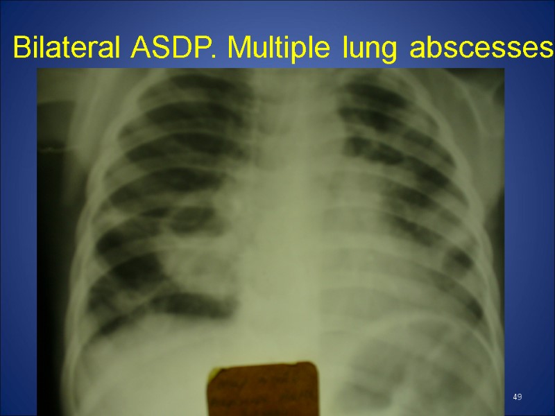 Bilateral ASDP. Multiple lung abscesses 49